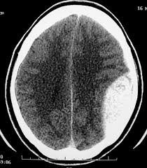 TC de crânio - hematoma epidural